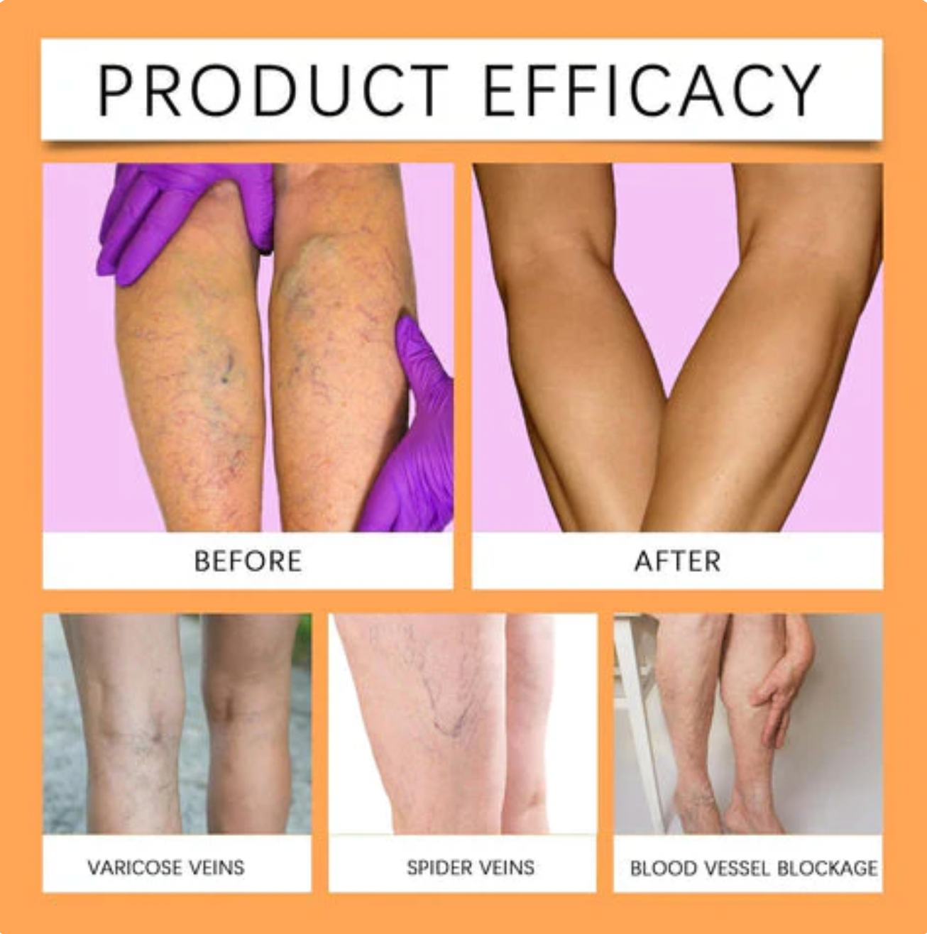 Turmeric Varicose Vein Relief Spray (BUY 1 GET 2 FREE 😍)