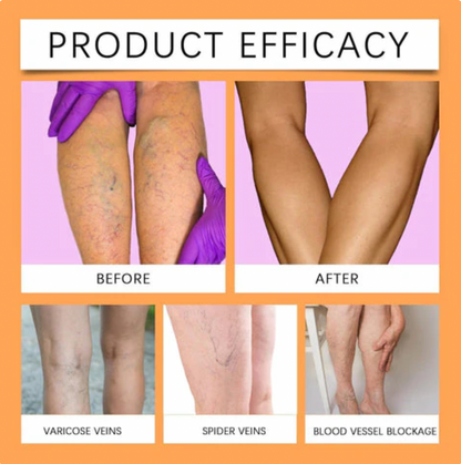 Turmeric Varicose Vein Relief Spray (BUY 1 GET 2 FREE 😍)